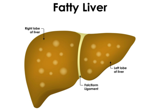Fatty Liver Fatty Liver