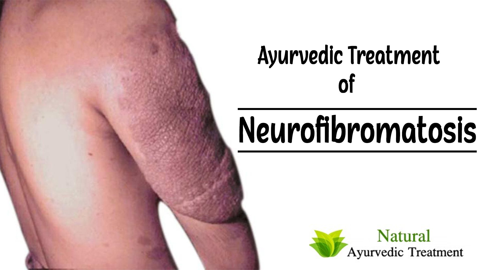 Ayurvedic Treatment of Neurofibromatosis - Causes, Symptoms & Herbal Remedies