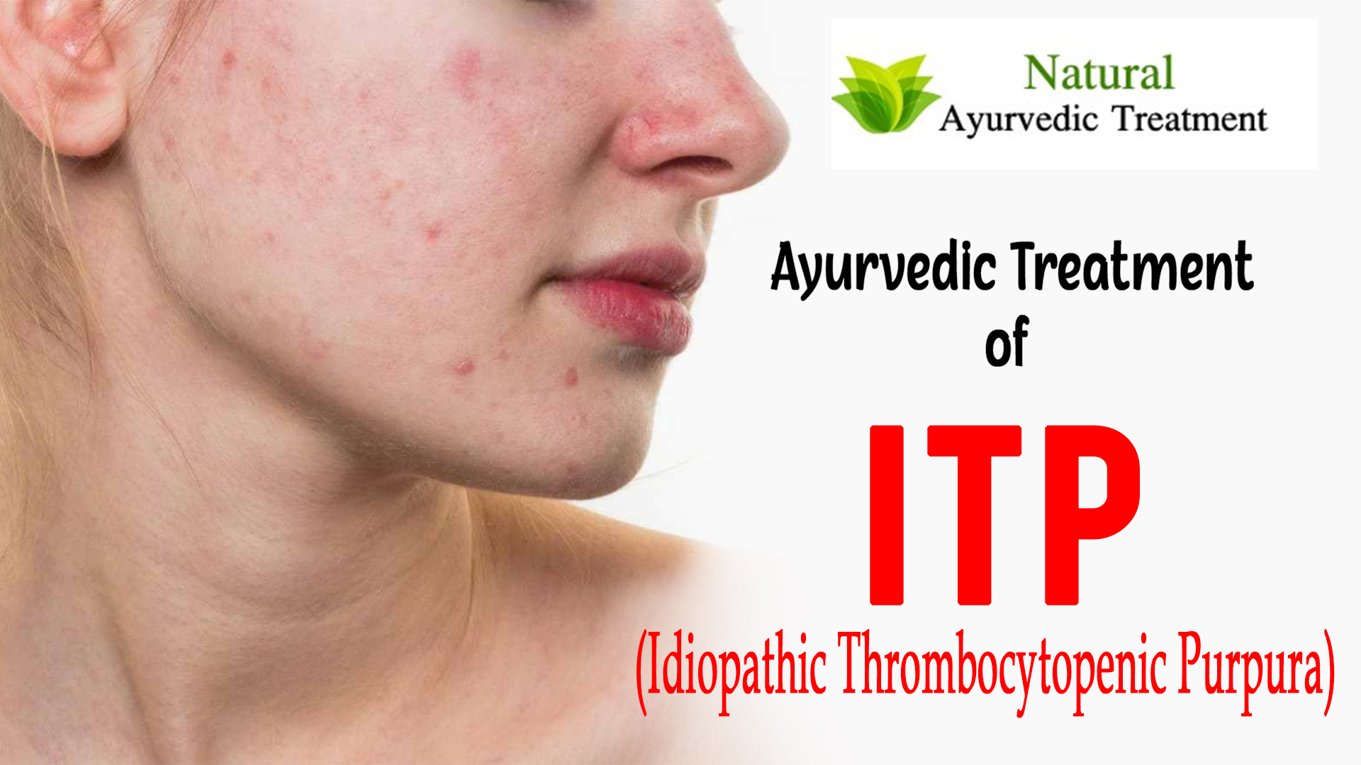 Watch Video Ayurvedic Management of Immune Thrombocytopenic Purpura-Low Platelet Count