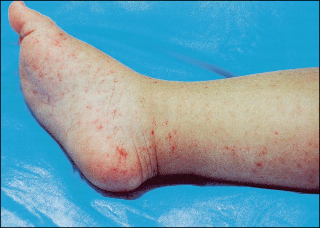 Herbal Treatment For Rocky Mountain Spotted Fever