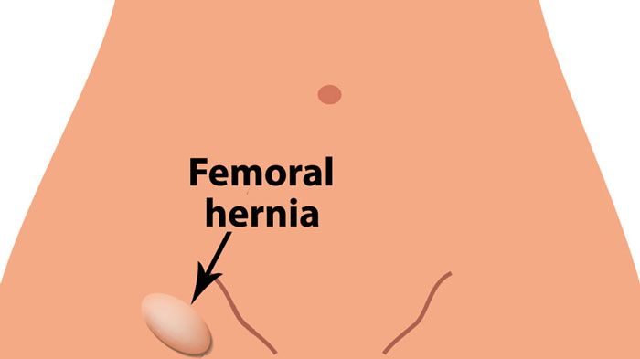 Femoral Hernia Femoral Hernia