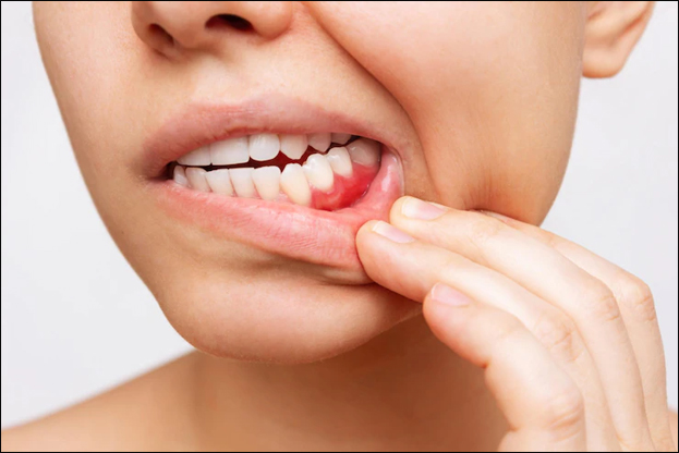 Home and Natural Remedies for Receding Gums Home and Natural Remedies for Receding Gums