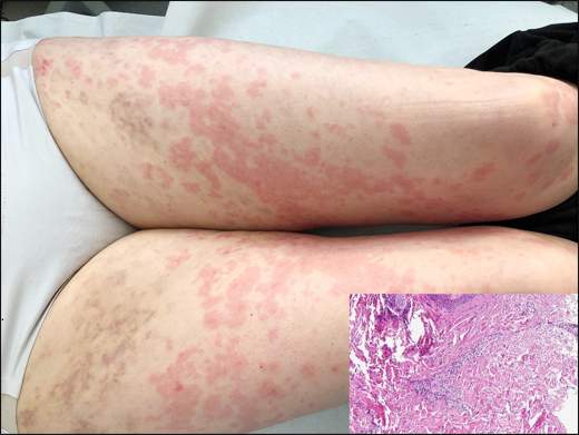 Urticarial Vasculitis Urticarial Vasculitis