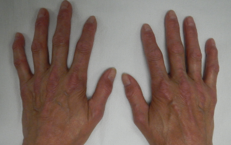 Crest Syndrome