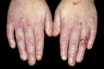 Epidermolysis Bullosa Epidermolysis Bullosa