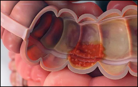 Ulcerative Colitis Ulcerative Colitis
