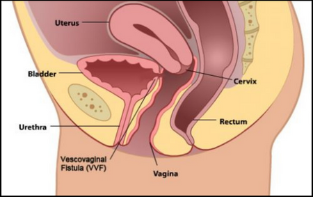 Ureterovaginal Fistula Ureterovaginal Fistula