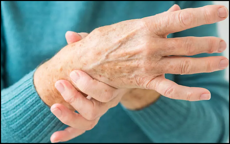 Carpal Tunnel Syndrome Carpal Tunnel Syndrome