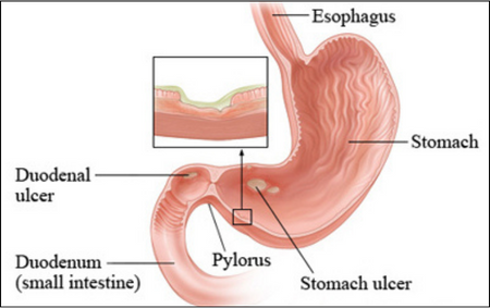 Duodenal Ulcers Duodenal Ulcers