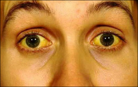 Leptospirosis in Humans Leptospirosis in Humans