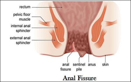 Anal Fistual or Fissure Anal Fistual or Fissure