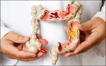 Irritable Bowel Syndrome Irritable Bowel Syndrome