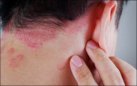Psoriasis