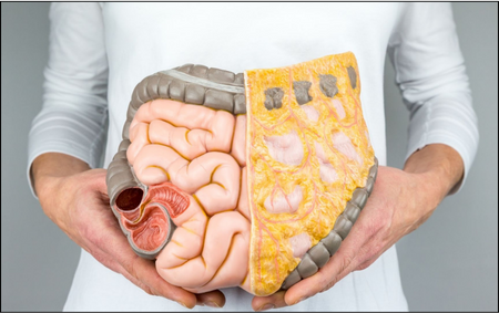 Ulcerative Colitis Ulcerative Colitis