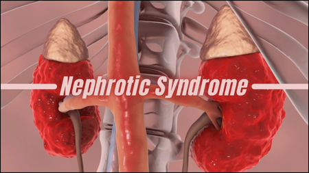 Nephrotic Syndrome Nephrotic Syndrome